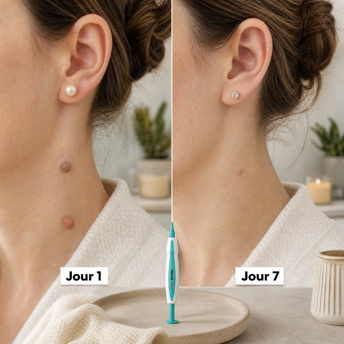 Kit Anti-Acrochordons — HELVIA SWISS