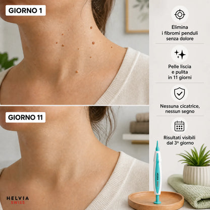 Kit Anti-Acrocordoni — HELVIA SWISS
